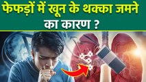 Pulmonary Embolism In Hindi: फेफड़ों में खून का थक्का जमने से क्या होता है | Symptoms,Causes |