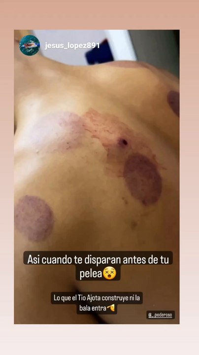 ÁNgel Bogado Preparandose Para Su Combate Tras Ser Baleado