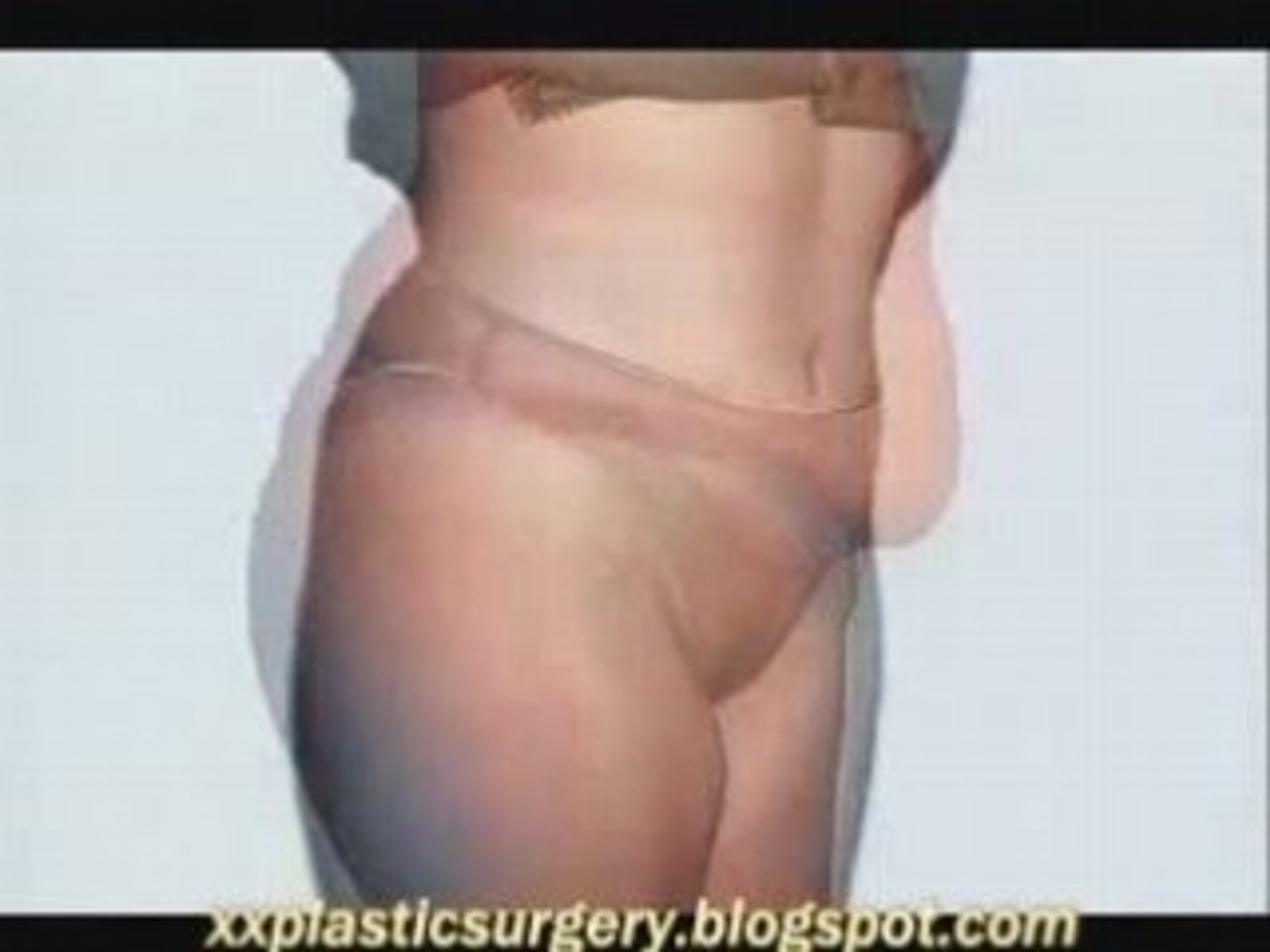 Plastic Surgery - Abdomin
