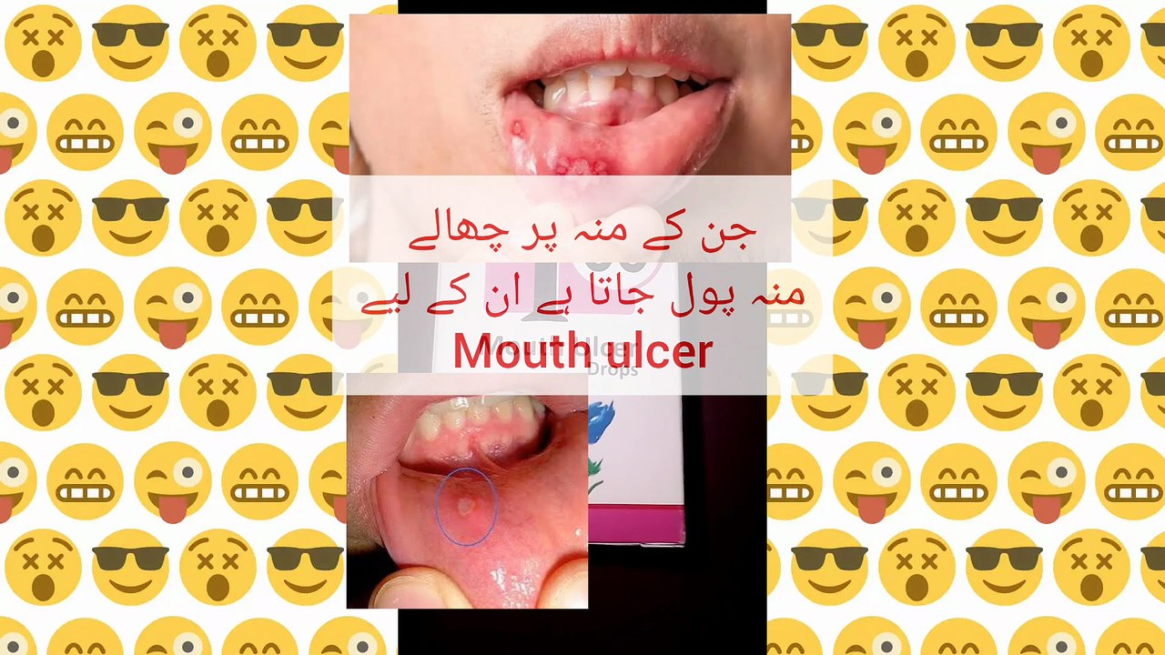 Mouth ulcer drop