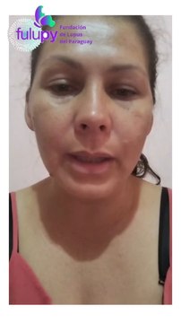 Rumilda Enciso Madre De Una Niña Con Lupus Clama Medicamentos Al Presidente De La República Santiago Peña