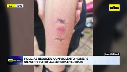 Mordió a un policía para no ser detenido: hombre tenía arresto domiciliario