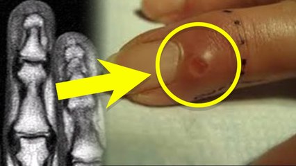 Ungli Me Tumor Kaise Hota Hai: उंगली में ट्यूमर कैसे होता है,गांठ होने पर क्या करें,इलाज |Boldsky