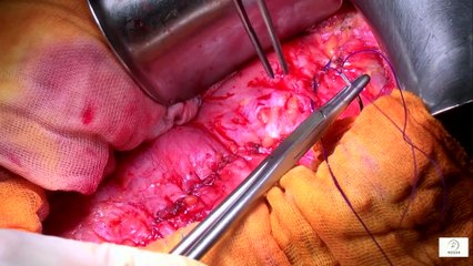 “Less Pain, More Precision The Rise of Robotic Surgery for Seniors”