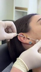 The Daith Piercing: Procedure, Healing, & Aftercare Guide #daithpiercing #earpiercing #helixpiercing
