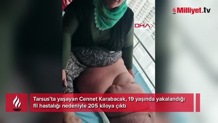 19 yaşında yakalandığı fil hastalığı nedeniyle 205 kiloya çıktı! 35 yıldır mücadele ediyor