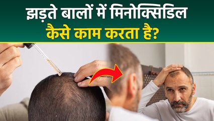 Minoxidil For Hair Loss: Minoxidil Lagane Se Kya Hota Hai | Minoxidil Ke Fayde Or Nuksan | Boldsky
