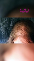 عاهة دائمة بسبب المينوكسيديل: ماذا حدث مع رحمة حسن؟