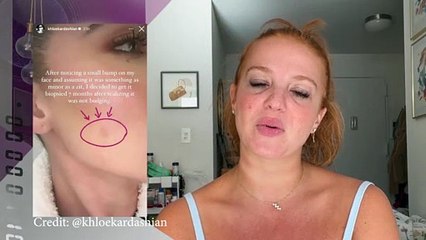 Khloe Kardashian Reveals Skin Cancer Scare After Having Tumor Removed From Her Face