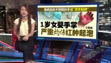 不锈钢扶手成“烫手陷阱”   1岁女婴手掌严重灼伤红肿起泡
