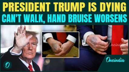 Trump Dying Slowly? Hand Bruise and Stair Fumble Raise Concerns About 79 Year Presidents Health