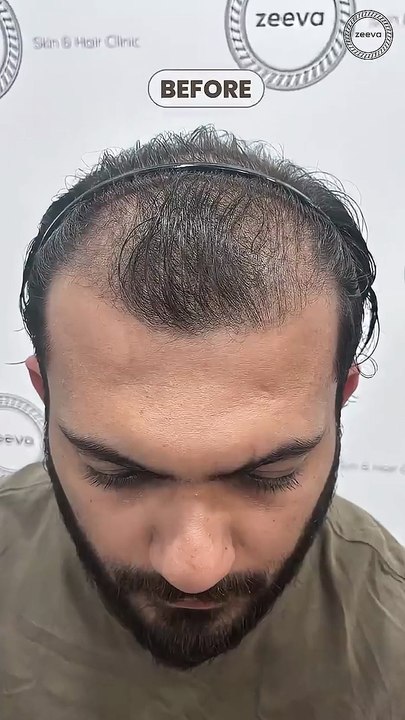 10-Month Hair Transformation #dranchalshah #Result #hairtransplant