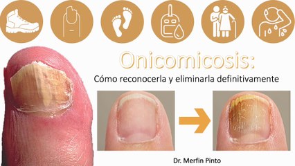Onicomicosis #elcuerpoymas #salud #medicina #Onicomicosis #Hongosenlasuñas