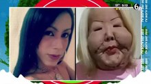 Influencer inicia reconstrucción facial tras vivir con el rostro desfigurado
