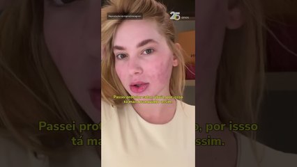 Virginia tranquiliza fãs após aparecer com rosto 'em carne viva' por procedimento estético #Shorts