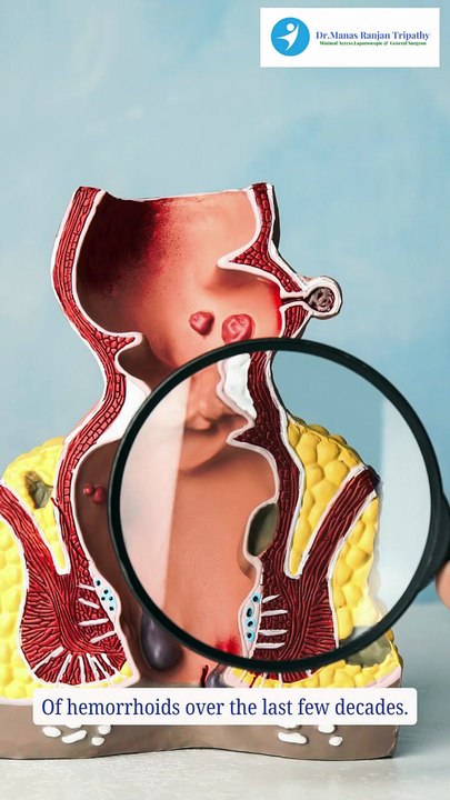 Role of Laser Treatment in Recurrent Hemorrhoids _ Dr. Manas Tripathy _ Piles Doctor in Bangalore