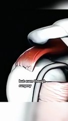 Rotator Cuff Repair Surgery Explained Procedure, Recovery & Tips