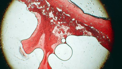 Leucemia mieloide aguda