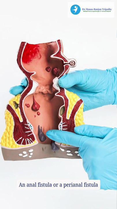 Dr. Talk_ What Causes Anal Fistula_ _ Best Proctologist in Koramangala _ Dr. Manas Tripathy