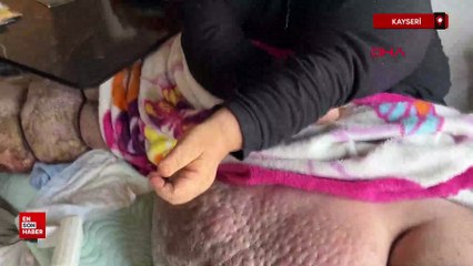 Kayseri  300 kiloya ulaşan fil hastasının hayali: Eşiyle kol kola caddede gezmek