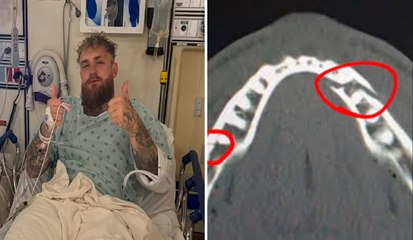 Jake Paul sale de cirugía mandíbula tras pelea con Anthony Joshua