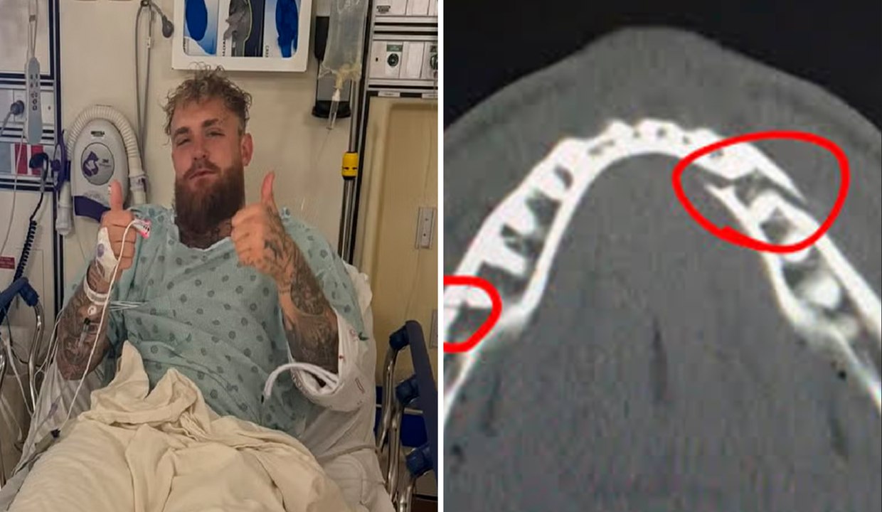 Jake Paul sale de cirugía mandíbula tras pelea con Anthony Joshua