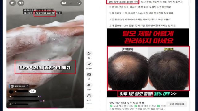 탈모 예방·억제 효과 온라인 부당광고 적발 / YTN