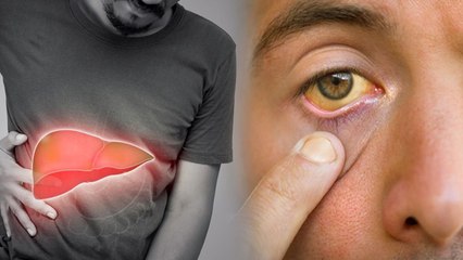 Liver Damage Signs In Eyes:लिवर खराब होने के लक्षण आँखों में क्या होते है|Yellow Eyes Liver Problems