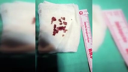 Estetik ameliyatı sırasında hastanın burnundan çıkanlar şoke etti