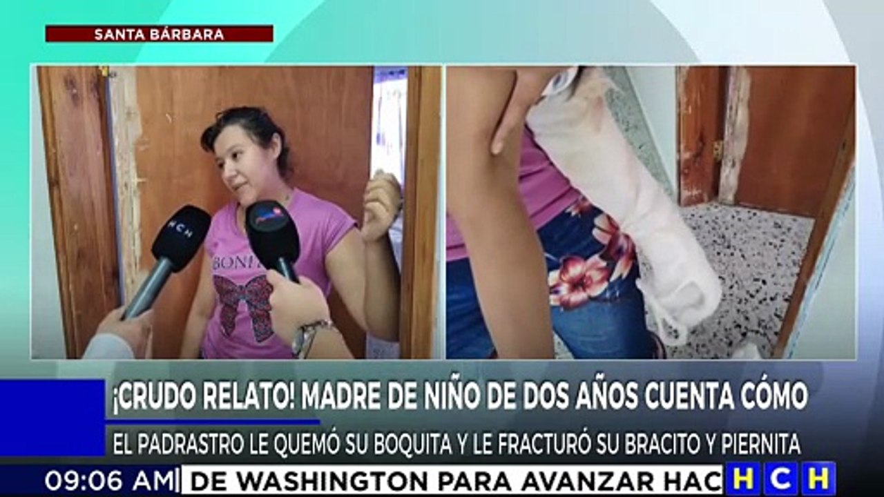 ¡Condenable! Salvaje sujeto, quemó la boca de su hijastro de 2 años con un tizón y le fracturó brazo y pierna