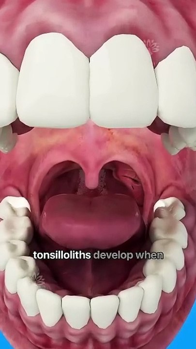 How Tonsils Stones are formed