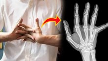 Finger Cracking Myths: क्या उंगलियां चटकने से गठिया होता है, Arthritis Real Reason | Fact Check...