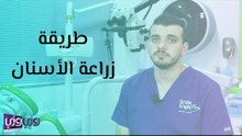 طريقة زراعة الأسنان
