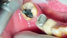 Dental cavities
