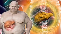 Liver cirrhosis Vs Liver Fibrosis: लिवर फाइब्रोसिस या लिवर सिरोसिस में अंतर | Symptoms & Causes..