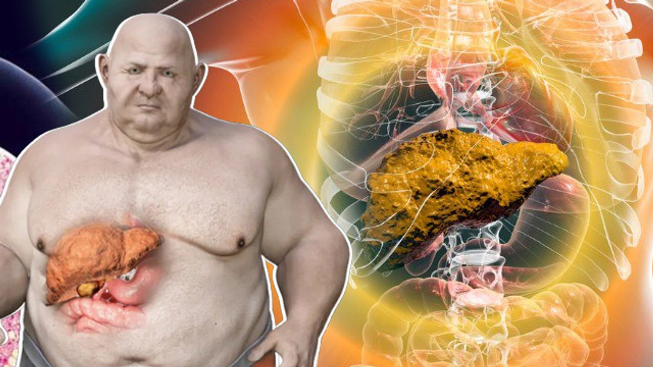 Liver cirrhosis Vs Liver Fibrosis: लिवर फाइब्रोसिस या लिवर सिरोसिस में अंतर | Symptoms & Causes..