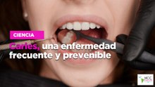 Caries, una enfermedad frecuente y prevenible.