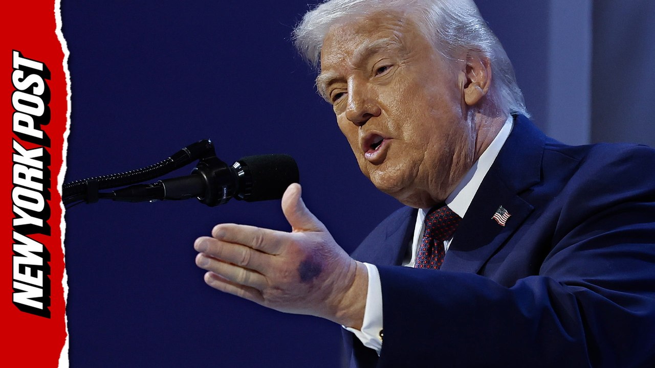 Trump reveals reason behind huge bruise on his hand