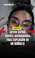 Joven sufrió graves graves quemaduras tras explosión de un buñuelo