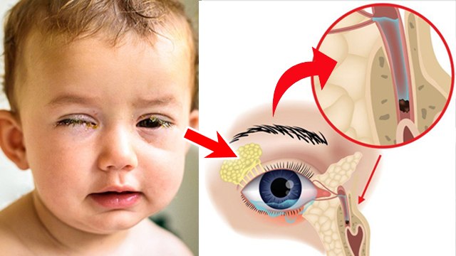 Bacche Ki Ankh Mein Kichad Aana: बच्चे की आंख में कीचड़ क्यों आता है,छुटकारा कैसे पाएं |Boldsky