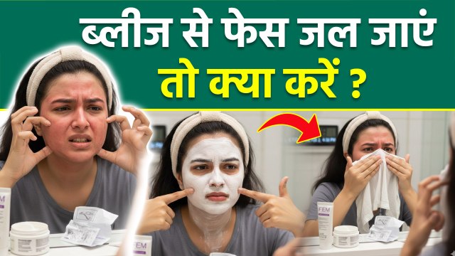 Bleach se Face Jal Jaye To Kya Kare: ब्लीच से फेस जल जाएं तो क्या करें,क्या लगाना चाहिए |Boldsky