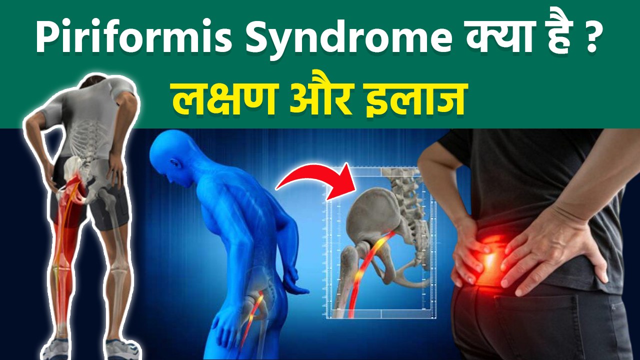 Piriformis Syndrome Treatment: Hip Pain Kyu Hota Hai,Reasons In Hindi | Boldsky
