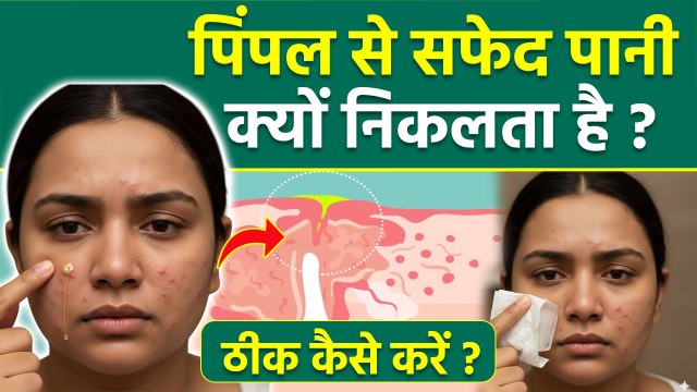 Pimple Se Pani Aana: पिंपल से सफेद पानी क्यों निकलता है,ठीक कैसे करें | White White Kyu Nikalta Hai?