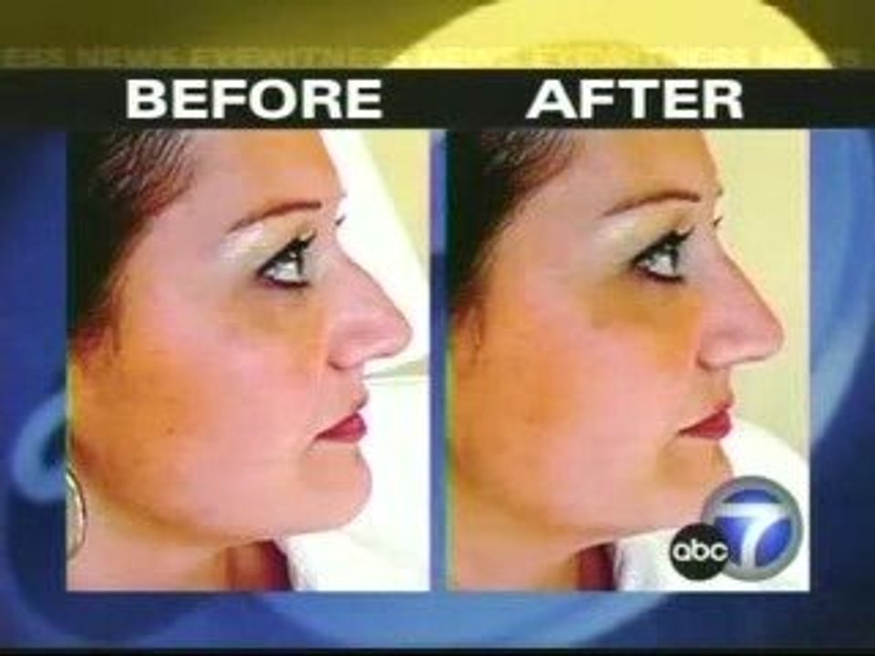 Non-Surgical Rhinoplasty