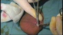 No-Scalpel, No-Needle Vasectomy HD Video-VasectomyStore.com