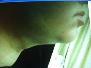 BRACHIOPLASTY-SKIN LIFTING-شد الجلد نحت الجسم -اطراف-ارداف-