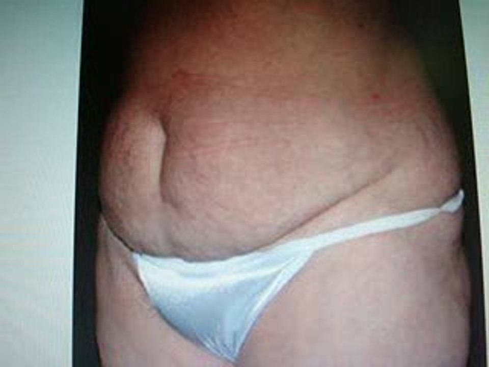 LIPOSUCTION-TUMMY TUCK-DUBAI-QATAR-شفط الدهون-تجميل-دبي-قطر-