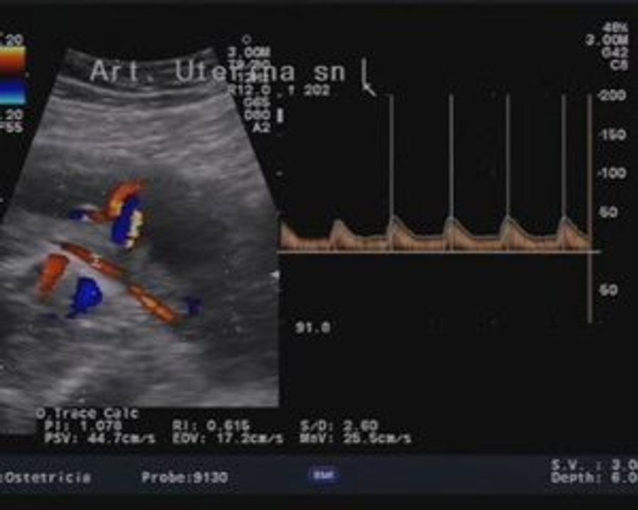 aorta a cavaliere