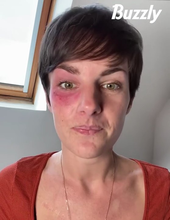 Atteinte d'algie vasculaire de la face, Diane nous raconte