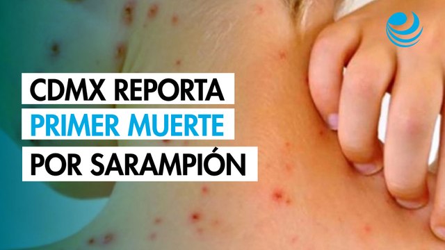 Salud confirma primera muerte por sarampión en CDMX; brote deja 28 fallecidos en el país